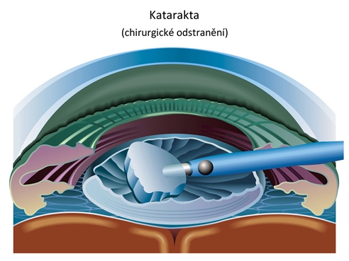 [2013/chirurgickeodstranenikatarakty.jpg]