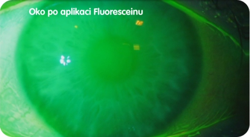 [design/2012/Oko%20po%20aplikaci%20Fluoresceinu.jpg]
