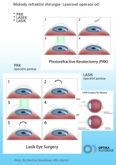 [design/2012/lasik2.jpg]